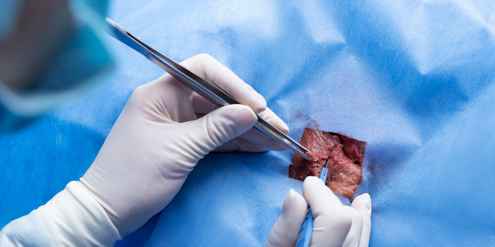 suture