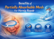 Benefits of Partially Absorbable Mesh For Hernia Repair
